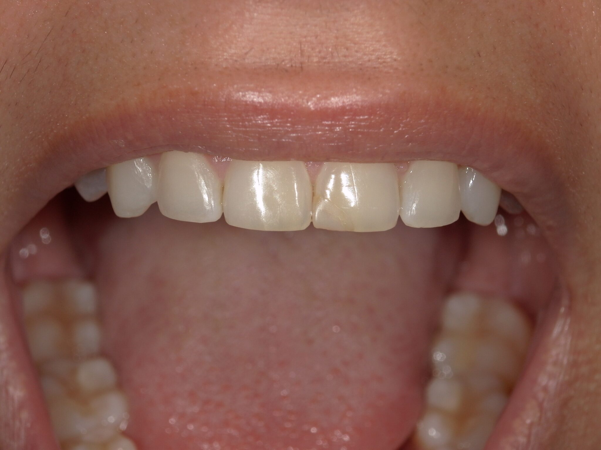 teeth translucent at tip